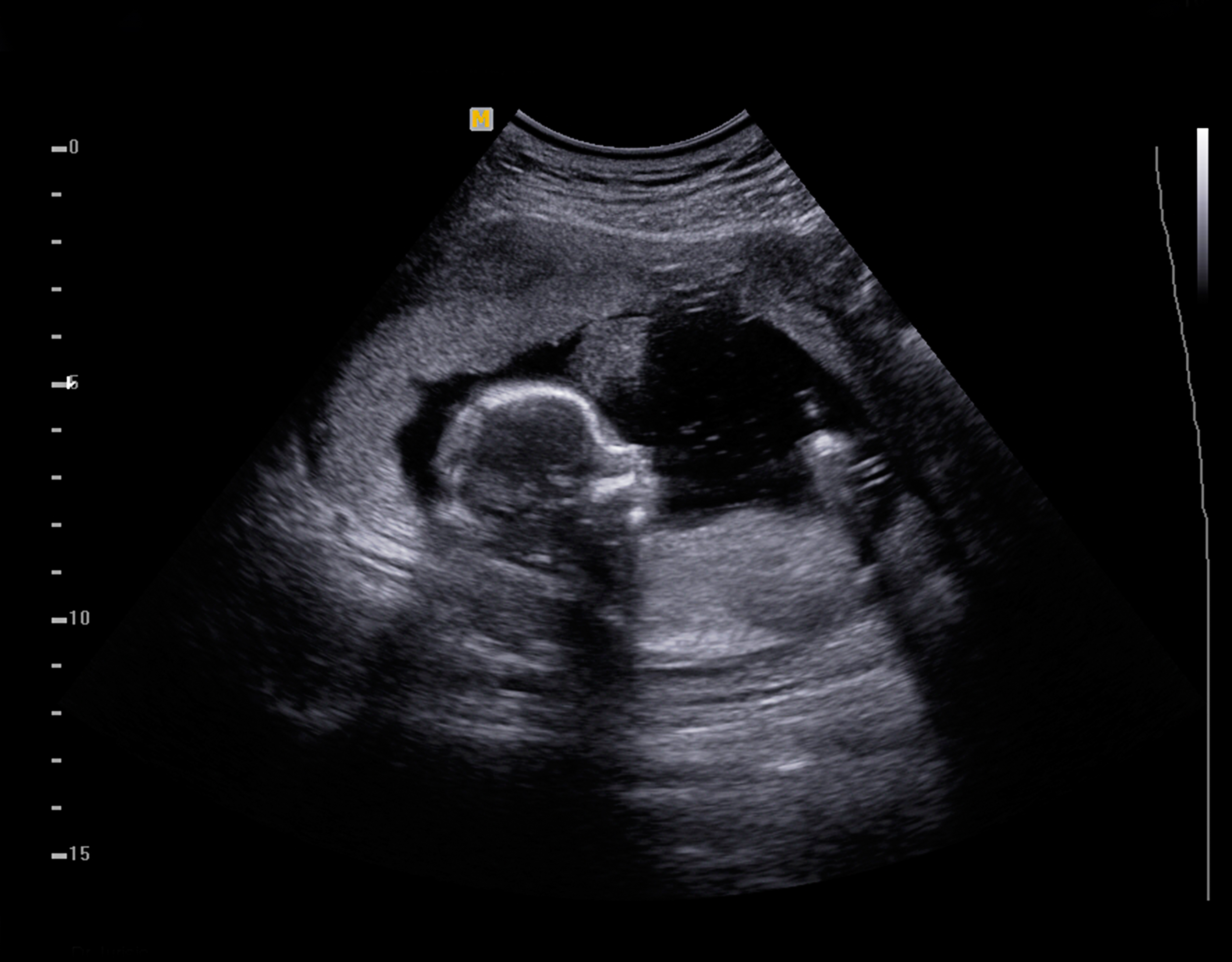 Baby Ultrasound Pictures 3