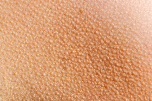 what-are-goose-bumps