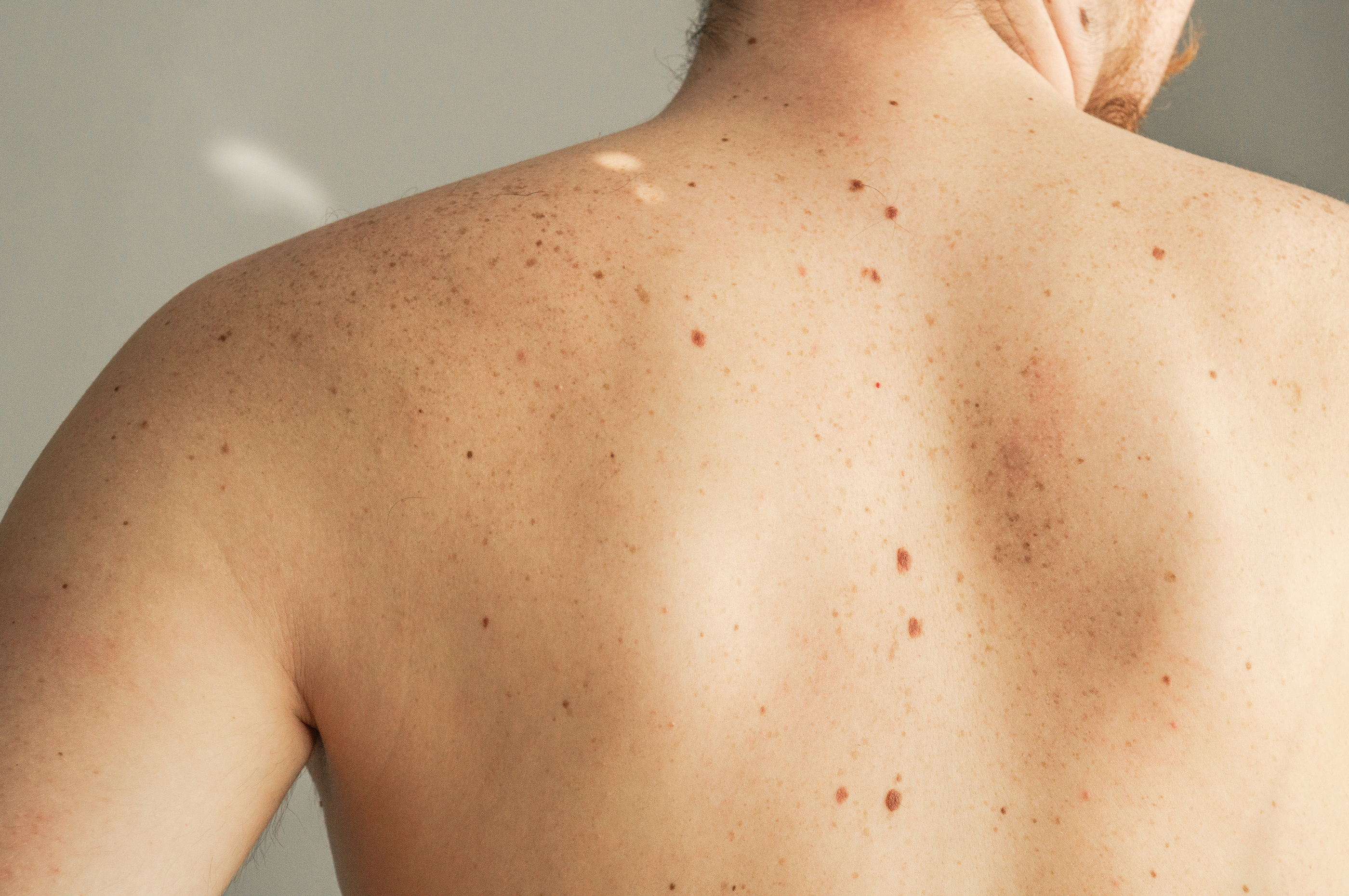 Why Do We Have Moles Over Our Bodies and What Do They Do?